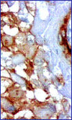 El inmunomarcaje con Actina muscular especfica se observa en la pared de los vasos y en la membrana y citoplasma de algunas clulas neoplsicas